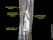 Extensor carpi radialis brevis muscle