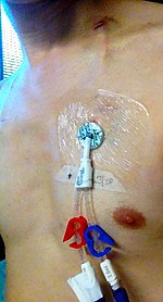 Photograph of an inserted Hickman line, which is a type of tunneled catheter, inserted in the chest.トンネル型カテーテルの一種であるヒックマンラインを胸部に挿入した写真。トンネル型カテーテルの一種であるヒックマンラインを胸部の皮膚から挿入し、トンネル状にして喉の頸静脈に挿入する。