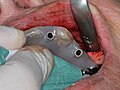 Implantat-Bohrschablone intraoral bei Implantation (Aufsicht)