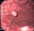 Gambar endoskopi polyposis kelenjar fundus manusia.