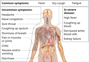 COVID-19 symptoms