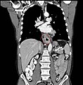 Kontrastni CT snimak koji pokazuje tumor jednjaka (koronski pogled)