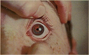 Wilson's Disease 2.jpg