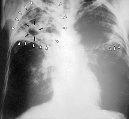 ’n X-straal van ’n persoon met gevorderde tuberkulose. Die infeksie in albei longe word met wit pyltjies aangedui, en ’n gat wat ontstaan met swart pyltjies.