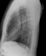 Lateral chest x-ray