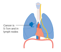 Stage IIB lung cancer