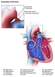 Coarctatio aortae