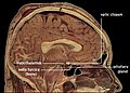 Sagitalni post mortem srednjelinijski presjek mozga. Corpus callosum je savijena traka u centru, iznad hipotalamusa.