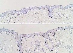 SOX10 immunohistochemistry of normal skin (top) and atypical melanocytic proliferation (bottom), seen mainly in hair follicles.