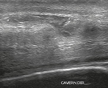 Figure 4 A: Ultrasound of the penis, right lateral view. Longitudinal section showing rupture of the tunica albuginea with an adjacent 1.92 cm hematoma (between calipers), due to trauma.[2]
