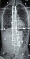 Beispiel einer langstreckigen Spondylodese mit vorderer und hinterer Fusion bei schwerer Skoliose