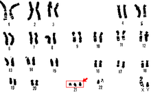 Zestaw chromosomów pogrupowanych w pary (kariogram), na którym chromosomy mają postać czarnych, najczęściej podłużnych plam. Zaznaczone miejsce, w którym zamiast pary chromosomów występują trzy chromosomy