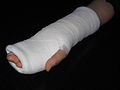 'n Hand geset in gips.