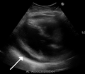 Ultrasons que mostren un vessament pericàrdic en algú amb pericarditis