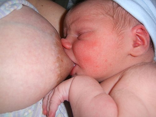 Enganxament deficient per a la lactància materna. El nas del nadó està contra el pit i la barbeta està inclinada lluny del pit, el que significa que la llengua i la mandíbula inferior del nadó no entren en contacte amb gran part de l'arèola. Això provoca dolor i un flux de llet deficient