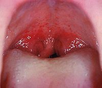 Miệng mở rộng cho thấy cổ họng Lưu ý các petechiae, hoặc các đốm đỏ nhỏ, trên vòm miệng mềm. Đây là một phát hiện không phổ biến nhưng đặc biệt cao trong viêm họng do liên cầu khuẩn.[10]