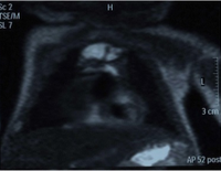 胸部MRI显示一名16天大的婴儿有血胸