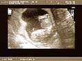 A dating scan at 12 weeks