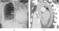 Extensive left-sided fibrothorax