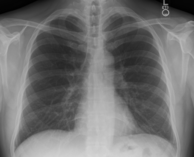 Chest X-ray PA