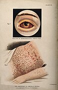 The eye in haemorrhagic smallpox & The eruption in variola nigra (J. A. Philip).jpg