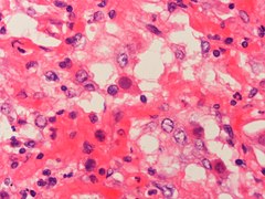 Adenovirus infection Case 161 (5443323651).jpg