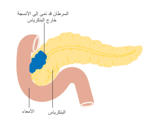 مرحلة T3 لسرطان البنكرياس.