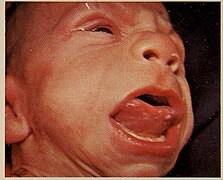 Hypoglycemia, Neonatal Macroglossia, Visceromegaly and Omphalocele 2.jpg