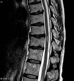 صورة بالرنين المغناطيسي توضح آفة بسبب التهاب النخاع المستعرض (الآفة هي اللون الأفتح، شكلها بيضوي في المركز باتجاه اليمين)، أخذت هذه الصورة بعد 3 أشهر من تعافي المريض.