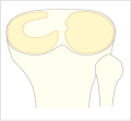 Scheibenmeniscus