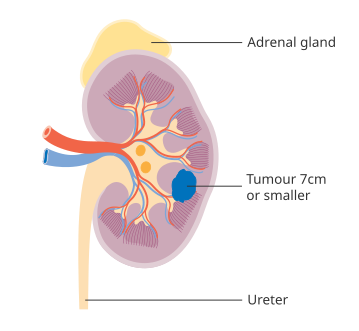 Stage 1 kidney cancer