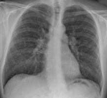 Chest_X-ray_of_sarcoidosis_nodules