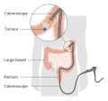 A diagram of a local resection of early stage colon cancer