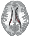 側脳室の中央部、前角、後角を上側から露出させた図