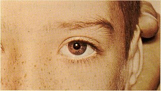 Wilson's Disease 3.jpg