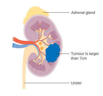 Stage 2 kidney cancer