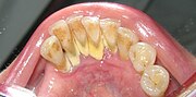 Thumbnail for Calculus (dental)