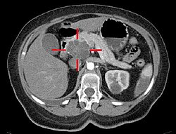 צילום CT המדגים גידול סרטני בראש הלבלב