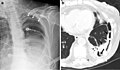 Chest X-ray (left) and CT scan (right) demonstrating fibrothorax