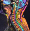 F: Posterior longitudinal ligament