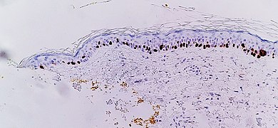 SOX10 immunohistochemistry facilitates showing lentigo maligna, as an increased number of melanocytes along stratum basale and nuclear pleumorphism. The changes are continuous with the resection margin (inked in yellow, at left), conferring a diagnosis of a not radically removed lentigo maligna.