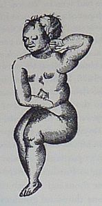 L'Enfant de pierre ou « Lithopédion de Sens » par Ambroise Paré.