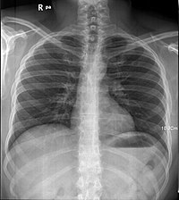 Rayos X del pulmón humano