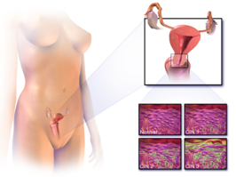 Plaats waar baarmoederhalskanker zich voordoet en voorbeelden van normale en abnormale cellen