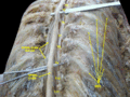 Orqa miya. Spinal membranalar va nerv ildizlari. Chuqur kesma. Orqadan koʻinishi.