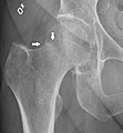 X-ray showing a suspected compressive subcapital fracture as a radiodense line