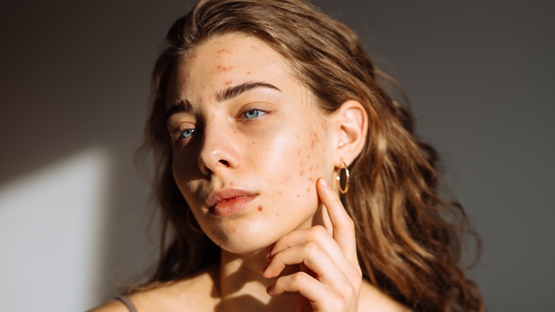 Woman with acne breakouts