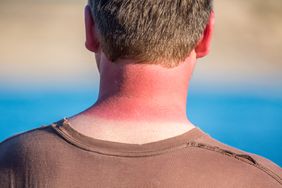 sun burnt neck on man