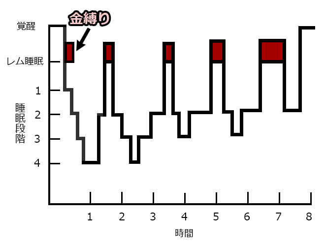 特殊なレム睡眠の例