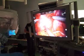 A patient undergoing robot-assisted surgery to remove the prostate in the ProMOTE study. Photo: Professor Alastair Lamb/University of Oxford/PA Wire